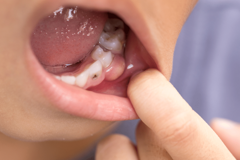 3 dureri dentare - abces infectie