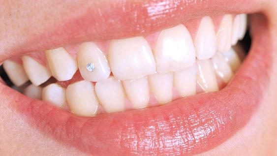 bijuterie-dentara