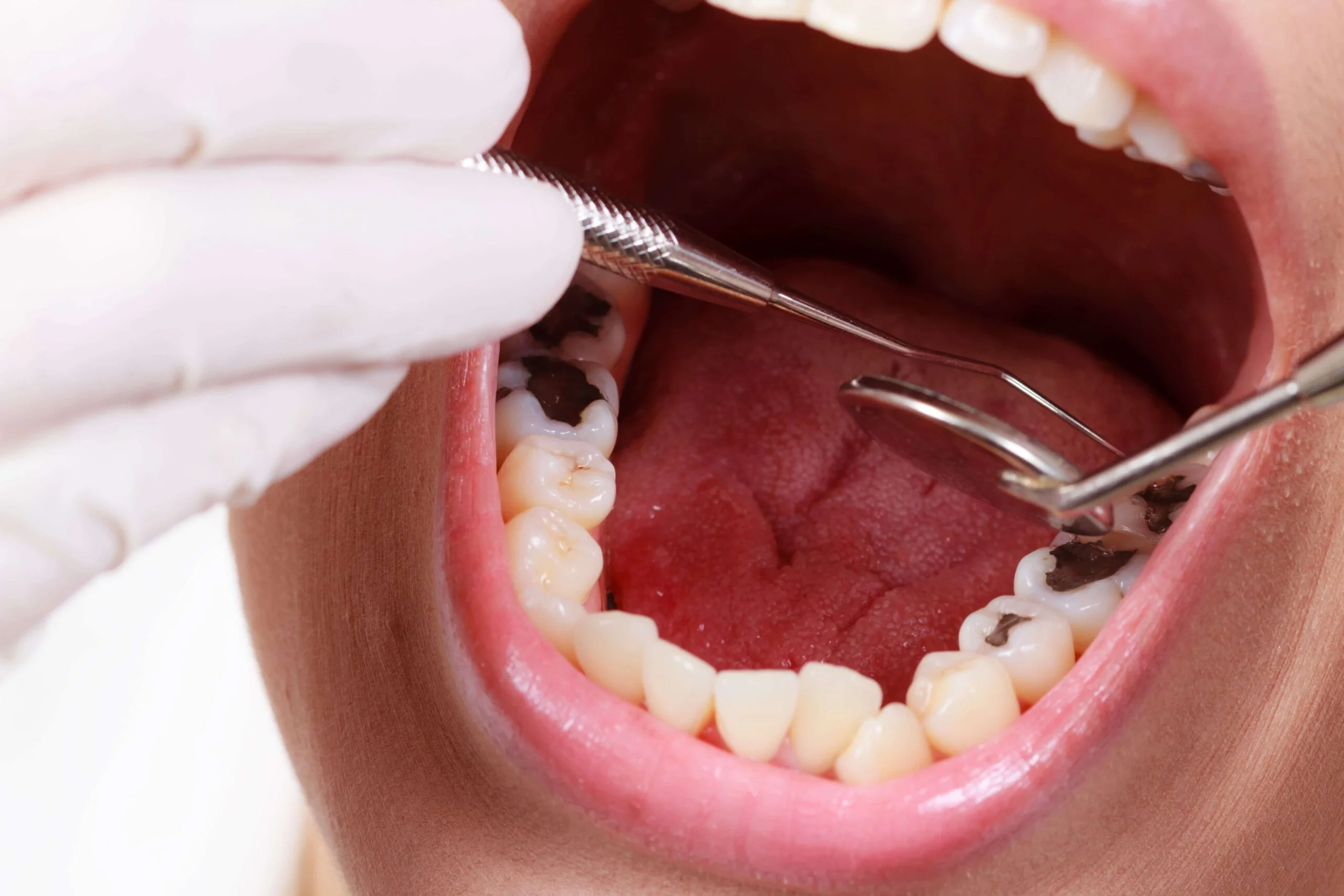 Cariile: Obiceiurile banale care iti distrug dantura + Ce boli risti daca NU tratezi dintii cariati
