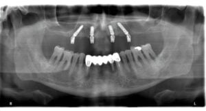 radiografie implant dentar