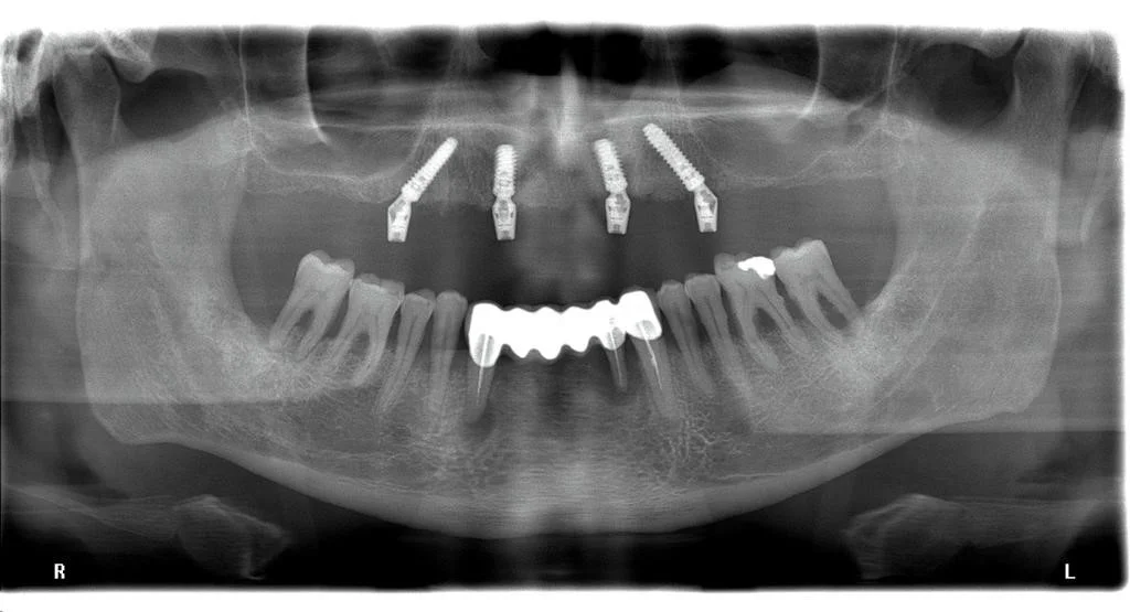 radiografie implant dentar