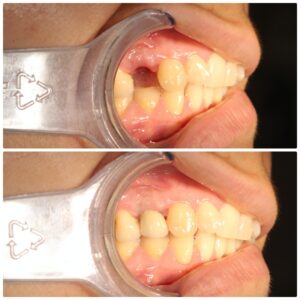 implant dentar before and after