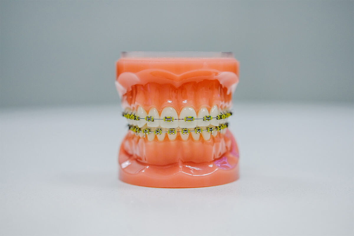 Aparat dentar fix sau mobil? Variantele sigure pentru dinți perfecți