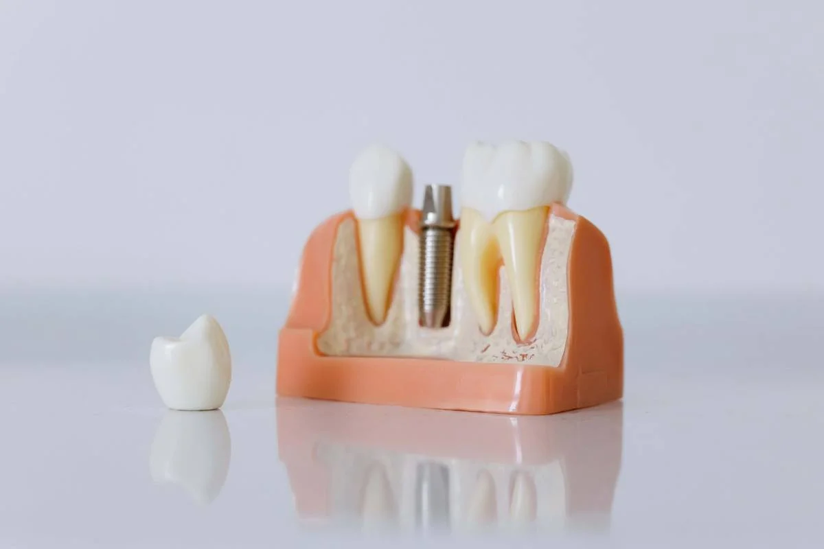 Amprenta pentru un dinte pe implant