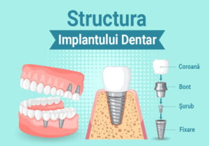 structura implantului dentar, coroana, bont, surub, fixare