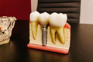 Varsta implant dentar - Afla daca esti candidatul ideal pentru inserarea implanturilor dentare