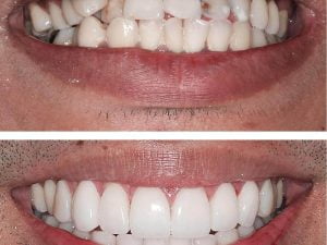 Tipuri de fatete dentare